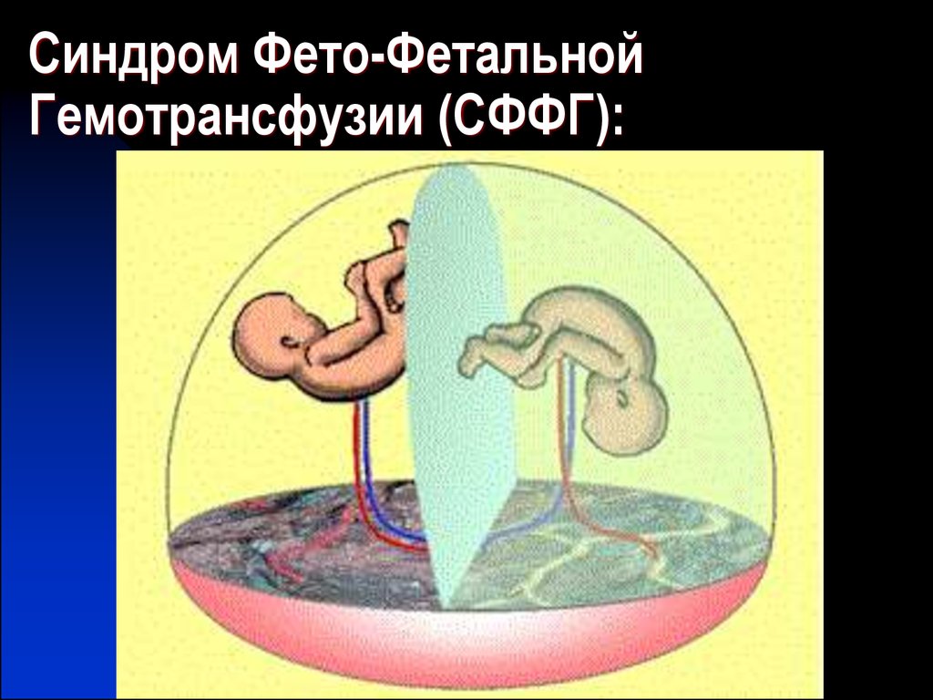 Фето фетальный трансфузионный синдром. Синдром фетальной трансфузии. Фето фетальный синдром. Фето-фетальный трансфузионный синдром (ФФТС). Синдром фетоплацентарной трансфузии.