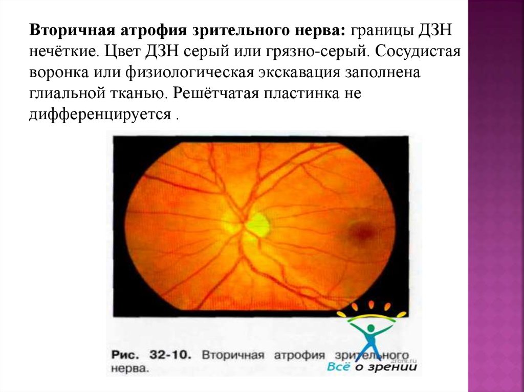 Норма зрительного нерва. Клинические признаки поражения зрительного нерва. Атрофия зрительного нерва клинические проявления. Постзастойная атрофия диска зрительного нерва. Симптомы патологии зрительного нерва.