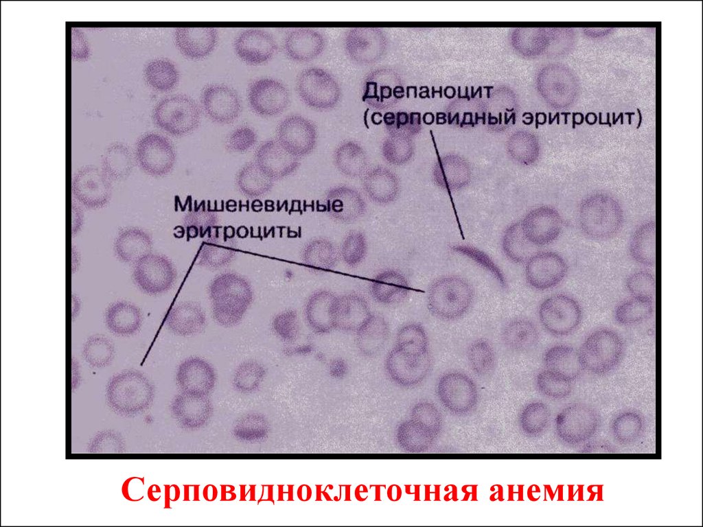 Эритроциты при серповидно клеточной анемии. Серповидноклеточная анемия мазок крови. Серповидноклеточная анемия эритроциты. Картина крови при серповидноклеточной анемии. Серповидноклеточная анемия микроскопия.