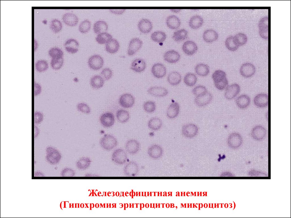Гипохромия железодефицитная анемия. Гипохромная анемия картина крови. Микроцитарная гипохромная анемия микроскоп. Анемия гипохромия микроцитоз. Гипохромная анемия мазок крови.