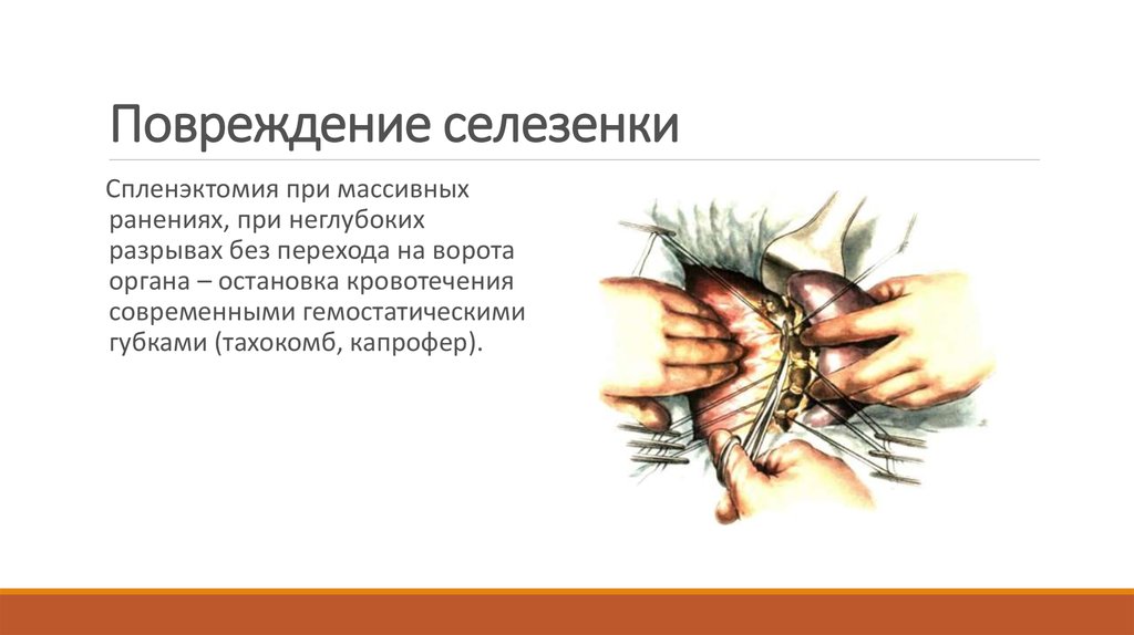 Удаление селезенки последствия. Паренхиматозное кровотечение селезенки. Травма селезенки классификация. Кровопотеря при разрыве селезенки. Разрыв селезенки классификация.