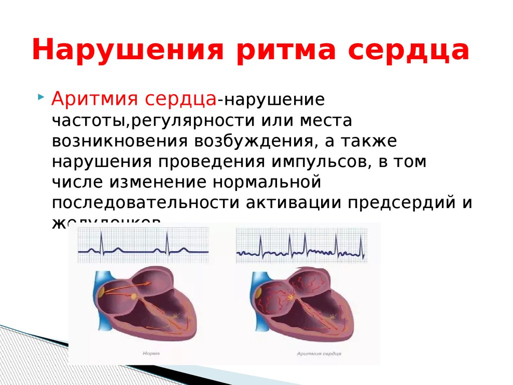 Аритмия и гипертония. Нарушения ритма сердца презентация. Нарушение ритма сердечной деятельности. Аритмия (нарушение ритма сердца). Аритмия сердца презентация.