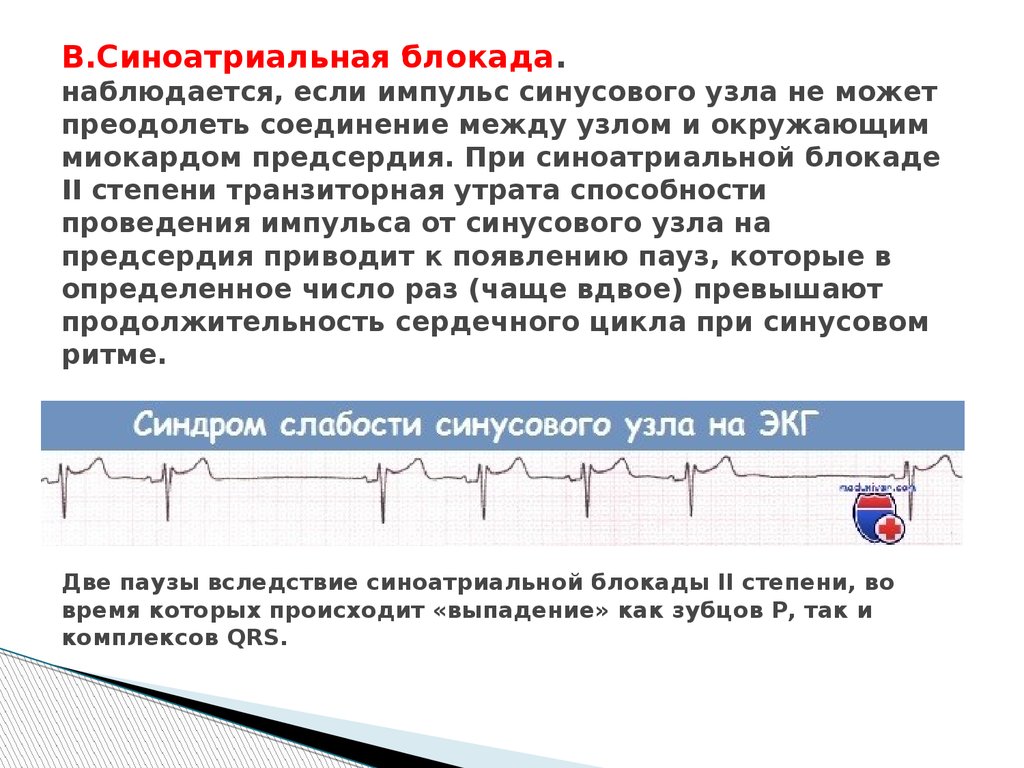 Признаки синоатриальной блокады. ЭКГ синоатриальной блокады. Синоатриальная блокада на ЭКГ. Синоатриальная блокада презентация. Синоатриальная блокада степени.