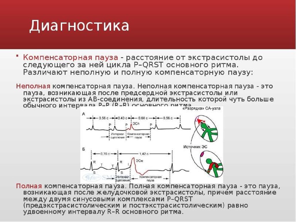 Ритма 7. Полная и неполная компенсаторная пауза на ЭКГ. Неполная компенсаторная пауза на ЭКГ. Экстрасистола и компенсаторная пауза. Экстрасистолы с неполной компенсаторной паузой.