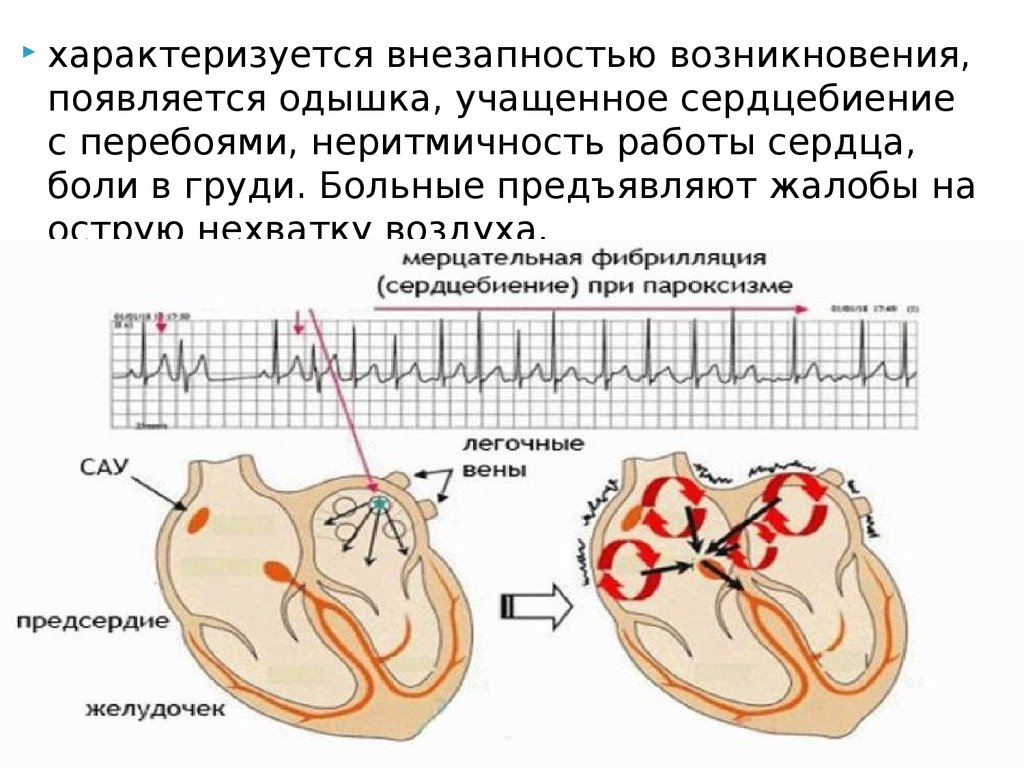 Сон сильное сердцебиение. Пароксизмальная форма фибрилляции предсердий. Пароксизмальная аритмия. Одышка и сердцебиение. Фибрилляция предсердий схема.