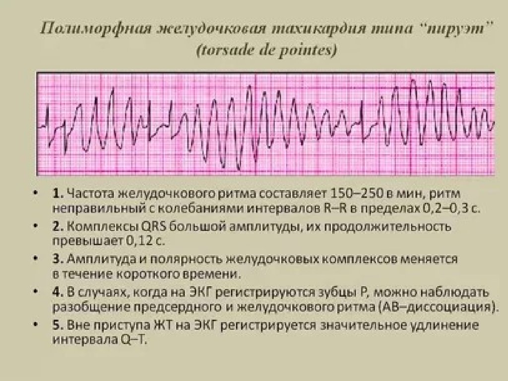 Желудочковое нарушение. Пароксизмальная полиморфная желудочковая тахикардия на ЭКГ. Желудочковая пароксизмальная тахикардия типа «Пируэт». Пируэтная желудочковая тахикардия ЭКГ. Веретенообразная желудочковая тахикардия ЭКГ.