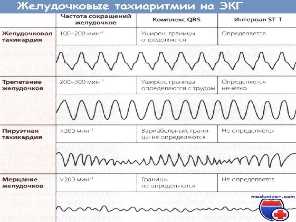 Аритмия карта вызова