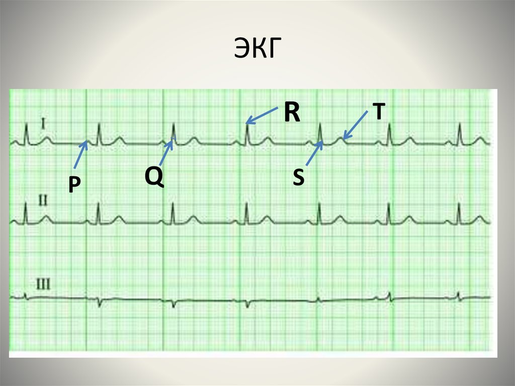 Экг. ЭКГ ECG eu08. ЭКГ кардиограмма норма нормальная. ЭКГ сердца норма снимок. ЭКГ снимки норма.