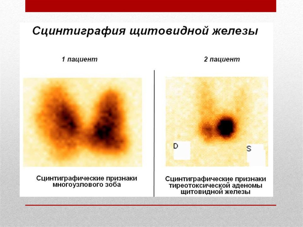 Сцинтиграфия щитовидной железы это