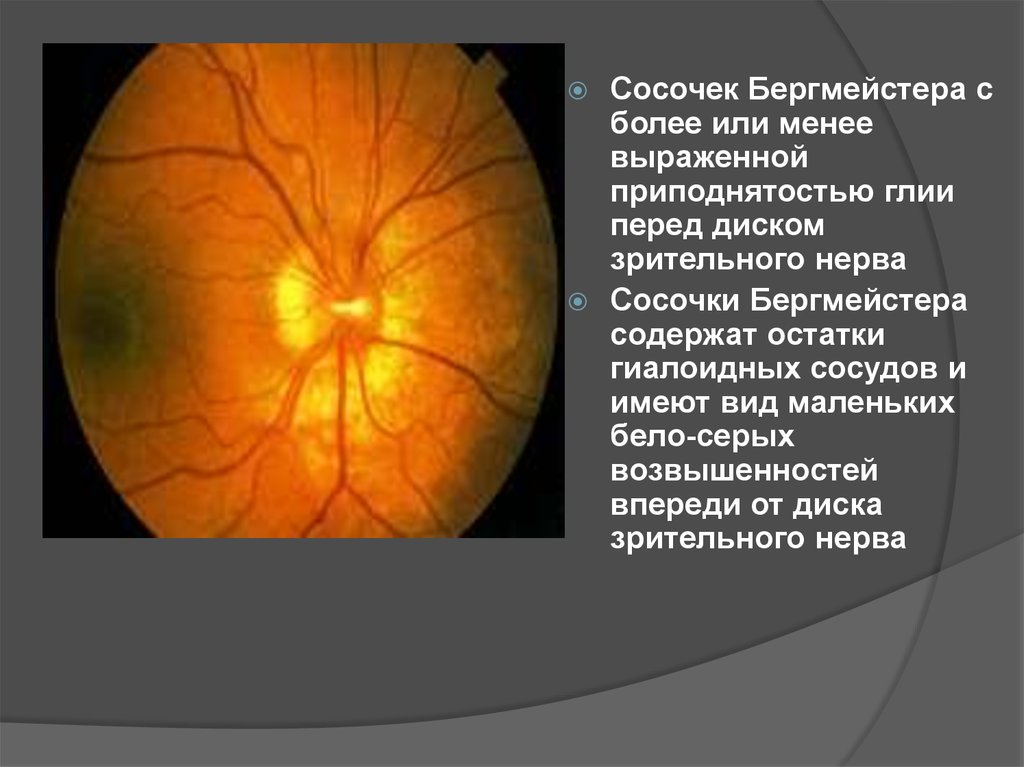 Периневральное пространство зрительного нерва. Решетчатая пластинка диска зрительного нерва. Ямочки диска зрительного нерва. Центральная ямка и диск зрительного нерва.
