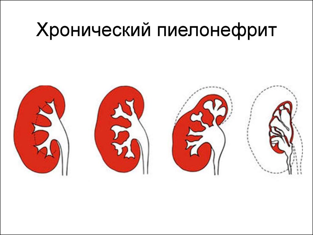 Почка после пиелонефрита