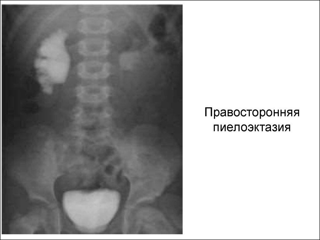 Пиелоэктазия почек что это. Экскреторная урография пиелоэктазия. Экскреторная урография гидронефроз. Гидронефроз почки на рентгенограмме. Гидронефроз почки урография.