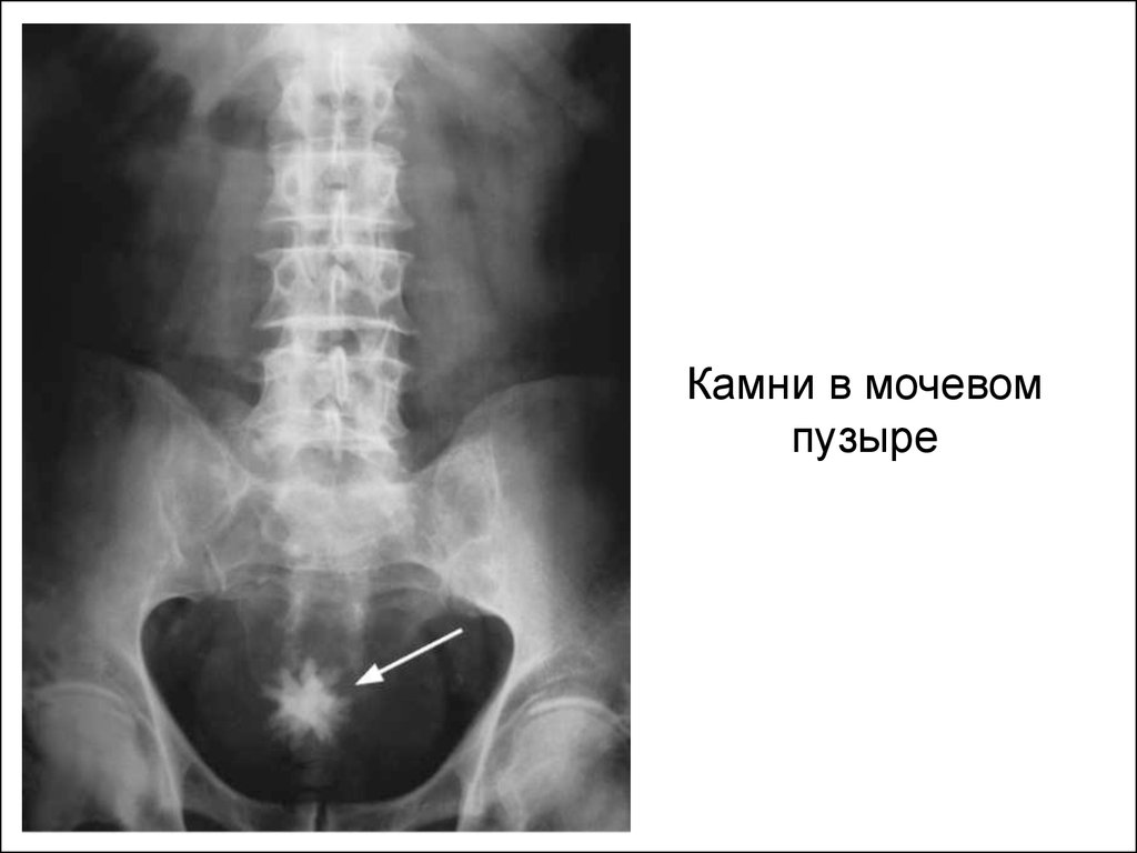 Камень нижней трети. Рентгенограмма камень в мочеточнике. Камни в мочевом пузыре рентген. Камень мочевой пузыря урография.