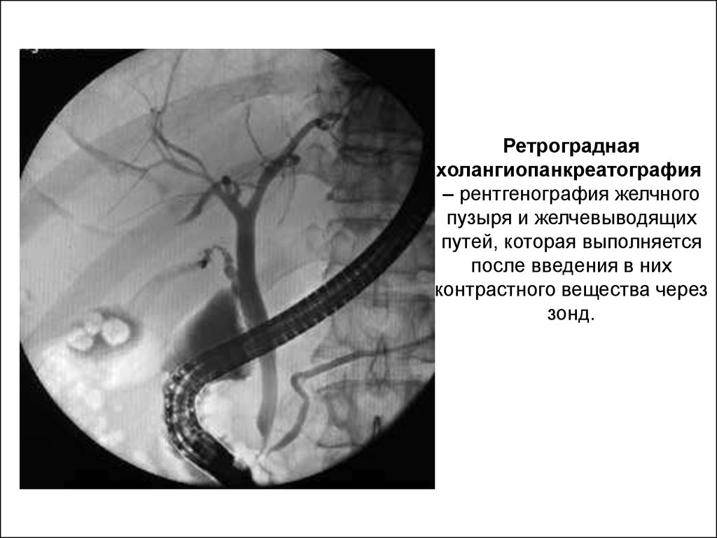 Ретроградная холангиопанкреатография – рентгенография желчного пузыря и желчевыводящих путей, которая выполняется после введения в них