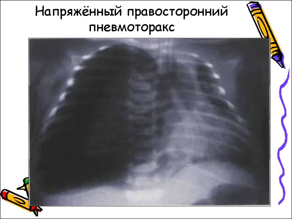 Напряженный пневмоторакс. Напряженный пневмоторакс рентген. Спонтанный правосторонний пневмоторакс. Пневмоторакс у новорожденных рентген. Парциальный пневмоторакс у новорожденных.