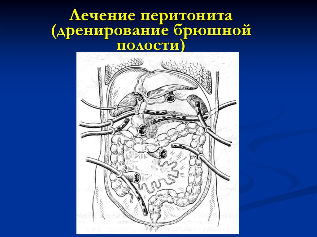 Дренирования полостей. Дренирование брюшной полости по Генералову. Дренирование селезенки. Вакуумное дренирование брюшной полости.