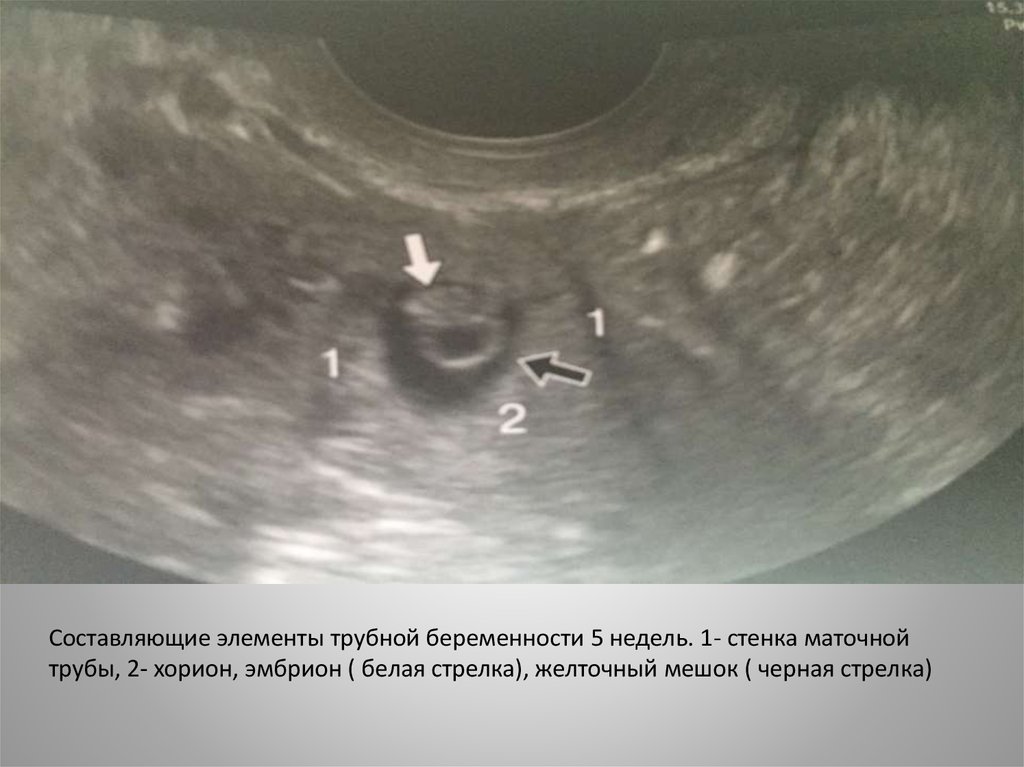 На узи видно внематочную. Беременность 6-7 недель желточный мешок 5.5. УЗИ внематочной беременности 5 недель. Плодное яйцо на УЗИ 5 недель. УЗИ желточный мешок 5 неделя.