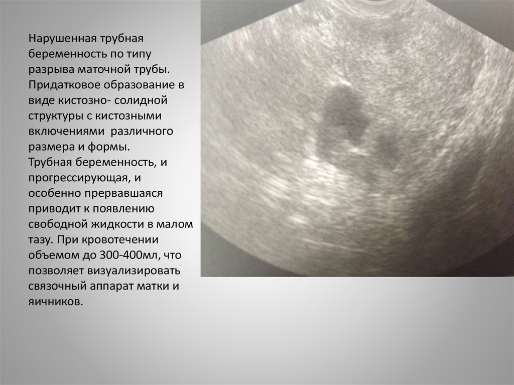 Маточная беременность на ранних сроках. Нарушенная Трубная беременность по типу разрыва трубы. Формы трубной беременности. Внематочная беременность. Трубная беременность УЗИ.