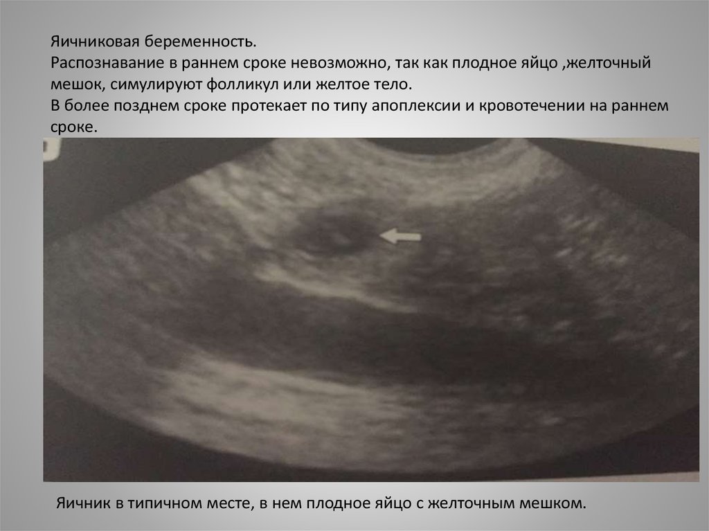 Тянет яичник при беременности на ранних. Яичниковая беременность на УЗИ. Плодное яйцо на раннем сроке беременности.