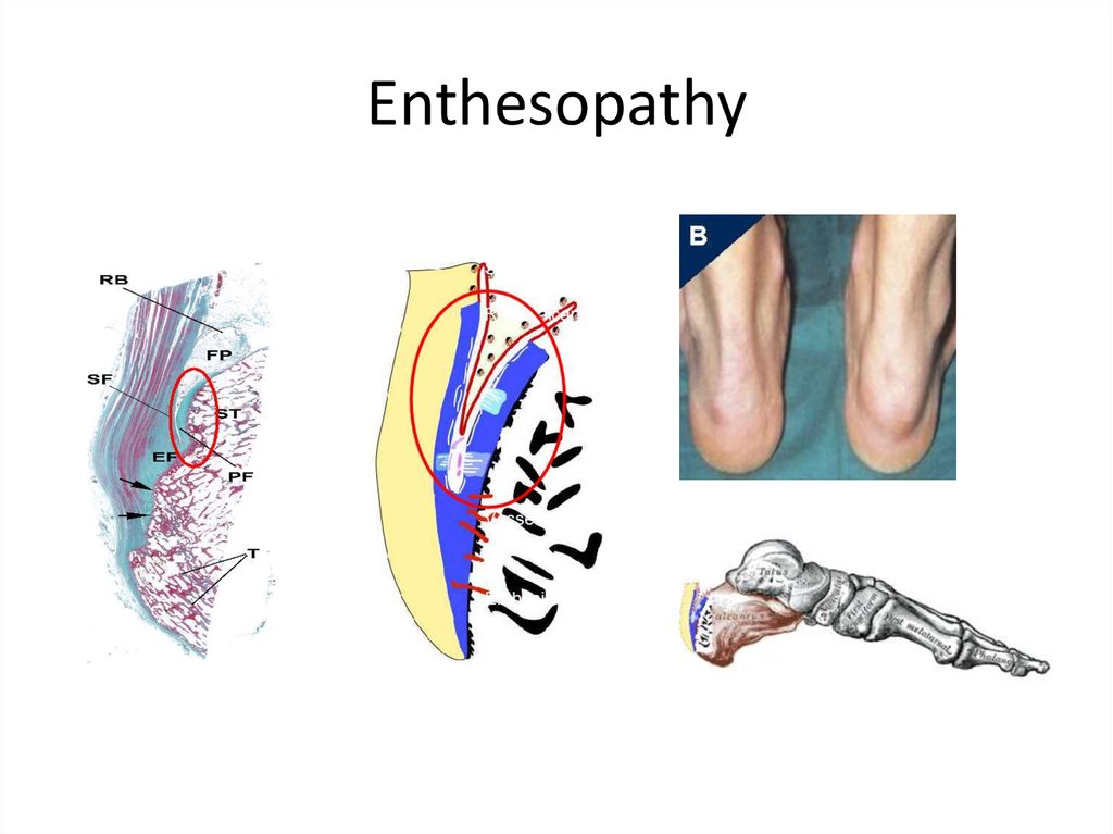 Энтезопатия что это такое. Энтезопатия ахиллова сухожилия. Энтезопатия нижней конечности. Плантарная энтезопатия.