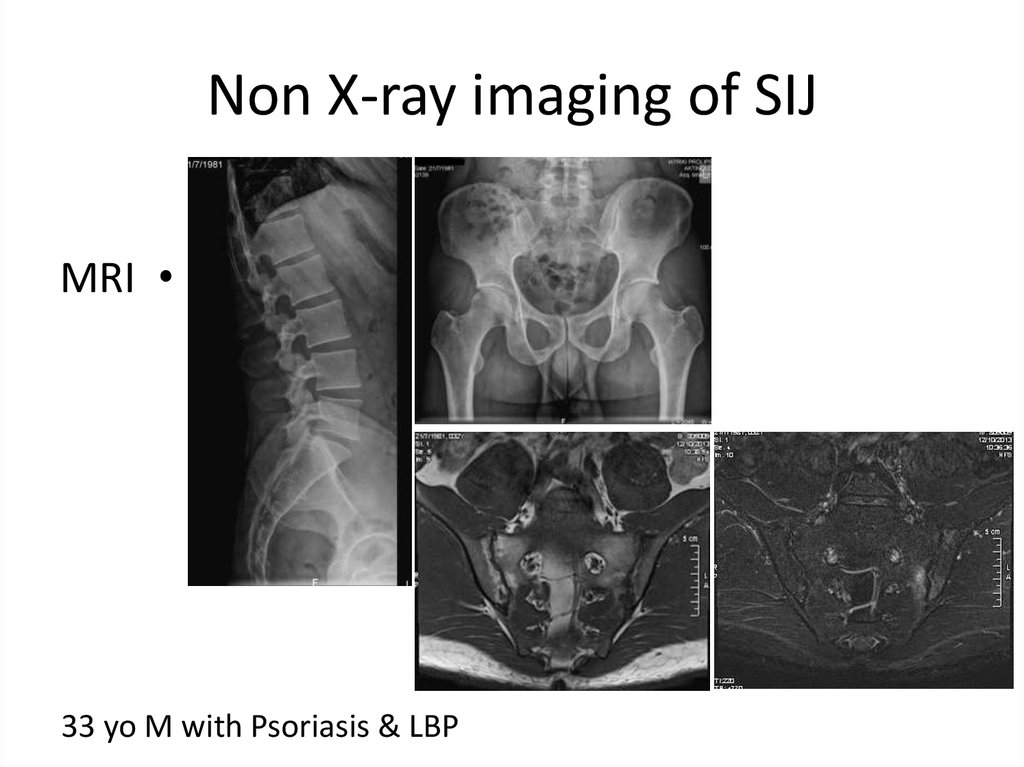 Ankylosing Spondylitis Online Presentation