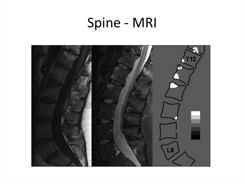 Spine - MRI