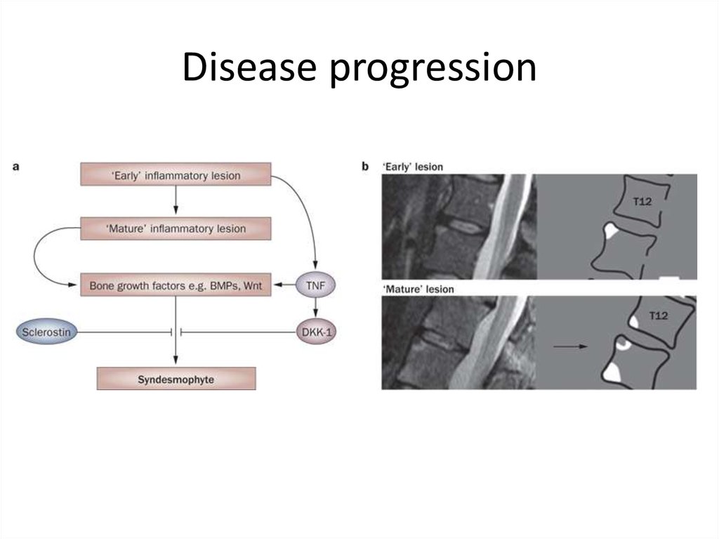 Disease progression