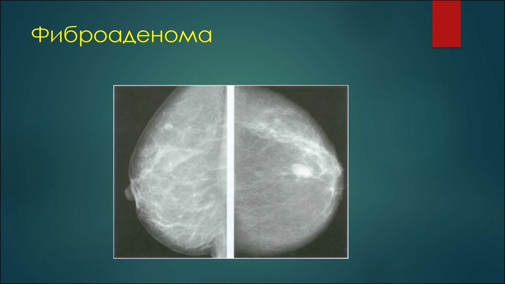 Диффузный фиброаденоматоз молочных желез что это такое. Фиброаденоматоз молочной железы рентген. Фиброаденома молочной железы рентген. Фиброзно кистозная мастопатия маммограмма. Листовидная фиброаденома рентген.