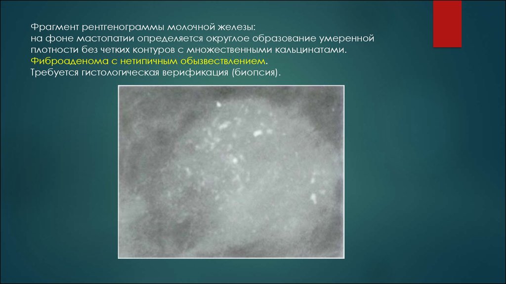 Кальцинаты в молочных железах. Доброкачественные кальцинаты молочных желез. Протоковые кальцинаты молочных желез. Микрокальцинаты молочной железы рентген. Образование с микрокальцинатами в молочной железе.