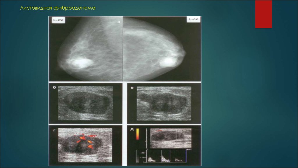 Форма фиброаденомы. Филлоидная опухоль молочной железы УЗИ. УЗИ молочных желез фиброаденома УЗИ. Фиброаденома мол жел УЗИ. Листовидная форма фиброаденомы молочной.