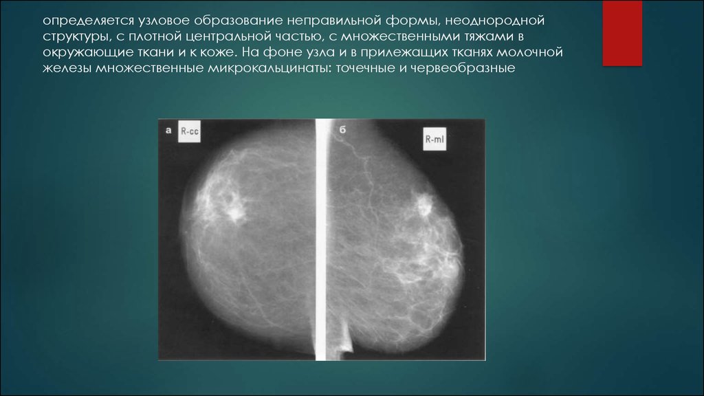 Умеренные фиброзные изменения. Фиброзная мастопатия молочных желез рентген. Фиброзно железистая структура молочной железы. Фиброзная мастопатия молочной железы рентген. Фиброзная ткань молочной железы.