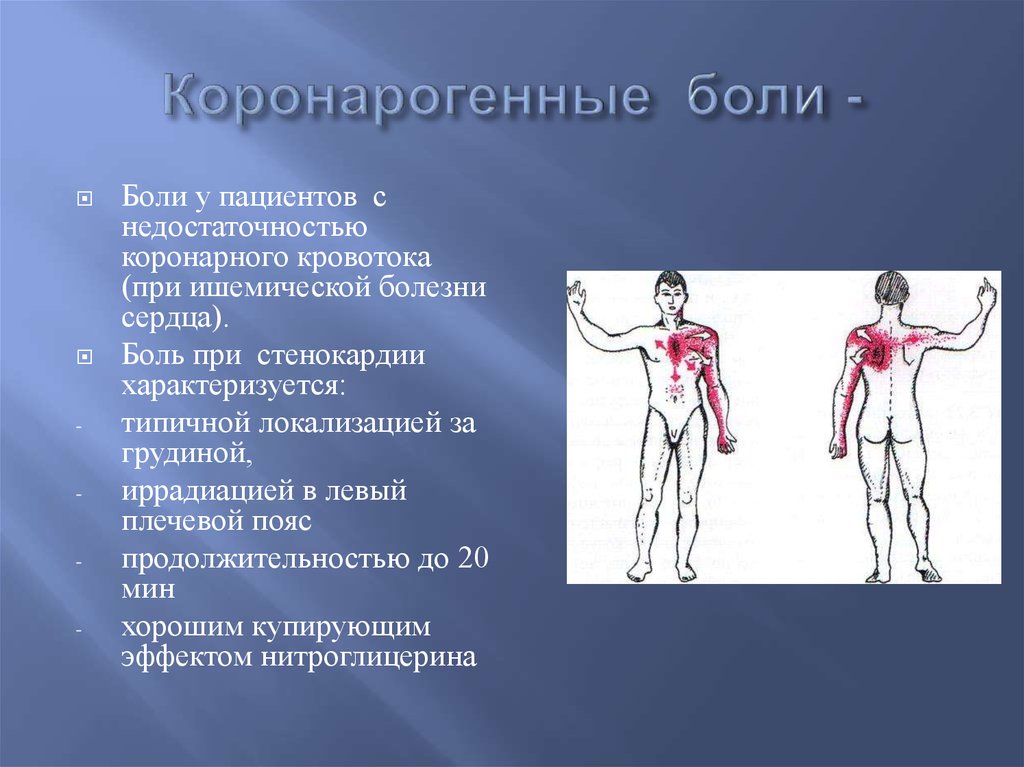 Иррадиация боли при стенокардии