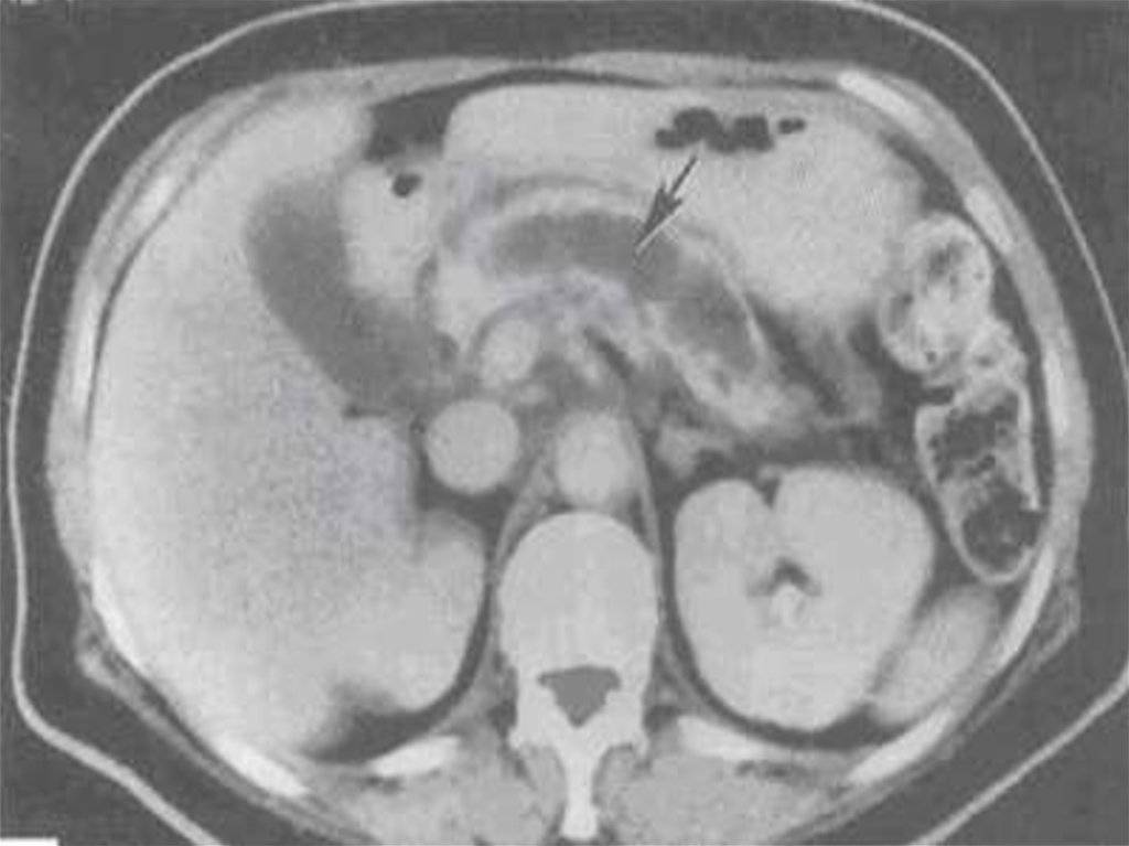 Кт картина острого панкреатита