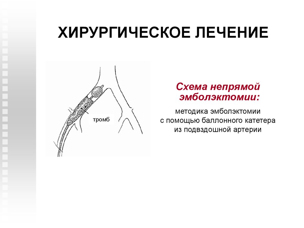 Артерия тромб удаление. Тромбоэмболия бедренной артерии. Патогенез эмболии бедренной артерии. Эмболия бедренной и подвздошной артерии. Тромбоэмболия сосудов нижних конечностей.