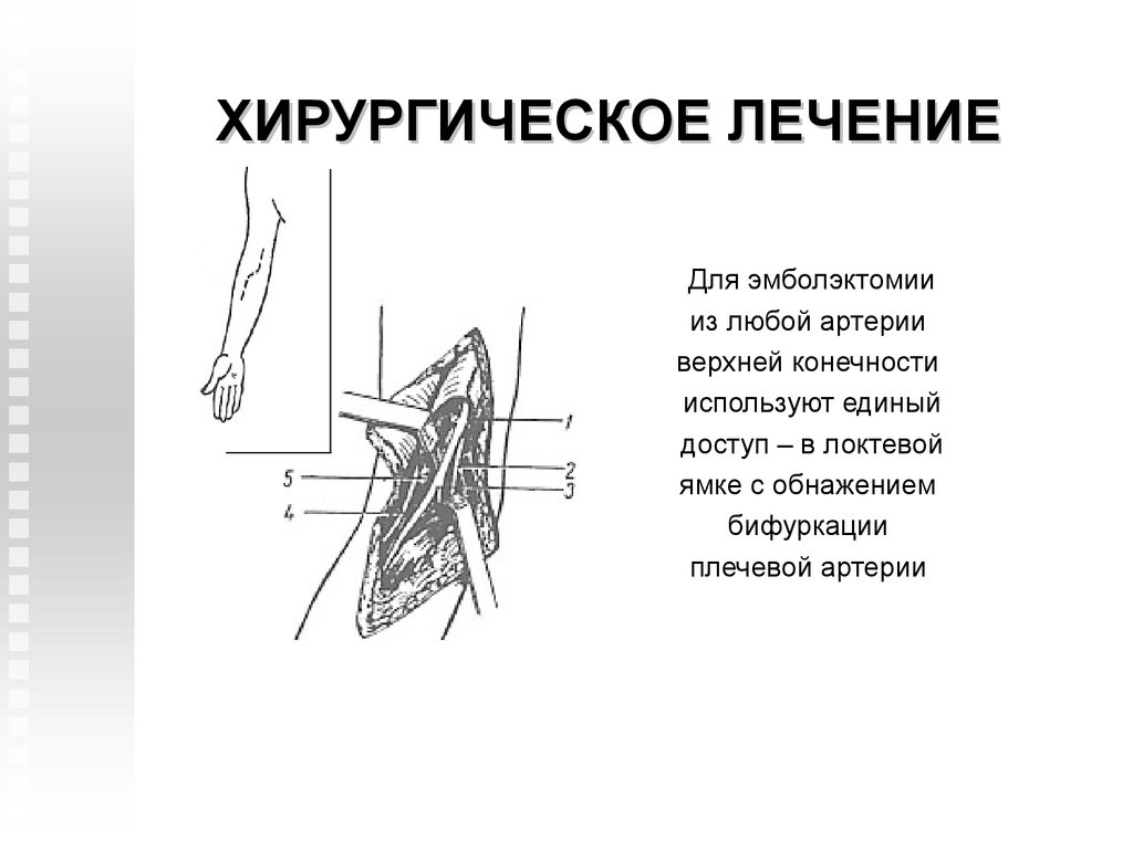 Острая артериальная непроходимость презентация хирургия