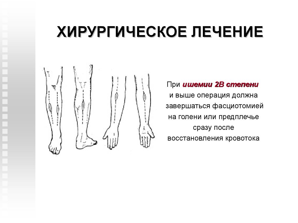 Классификация ишемии конечностей