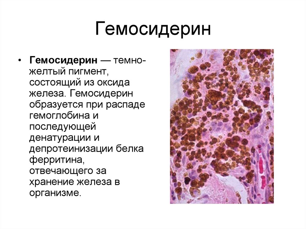 Железо в макрофагах. Гемосидерин гистология. Гемосидерин патогенез. Гемосидерин этиология. Гемосидерин кожа гистология.