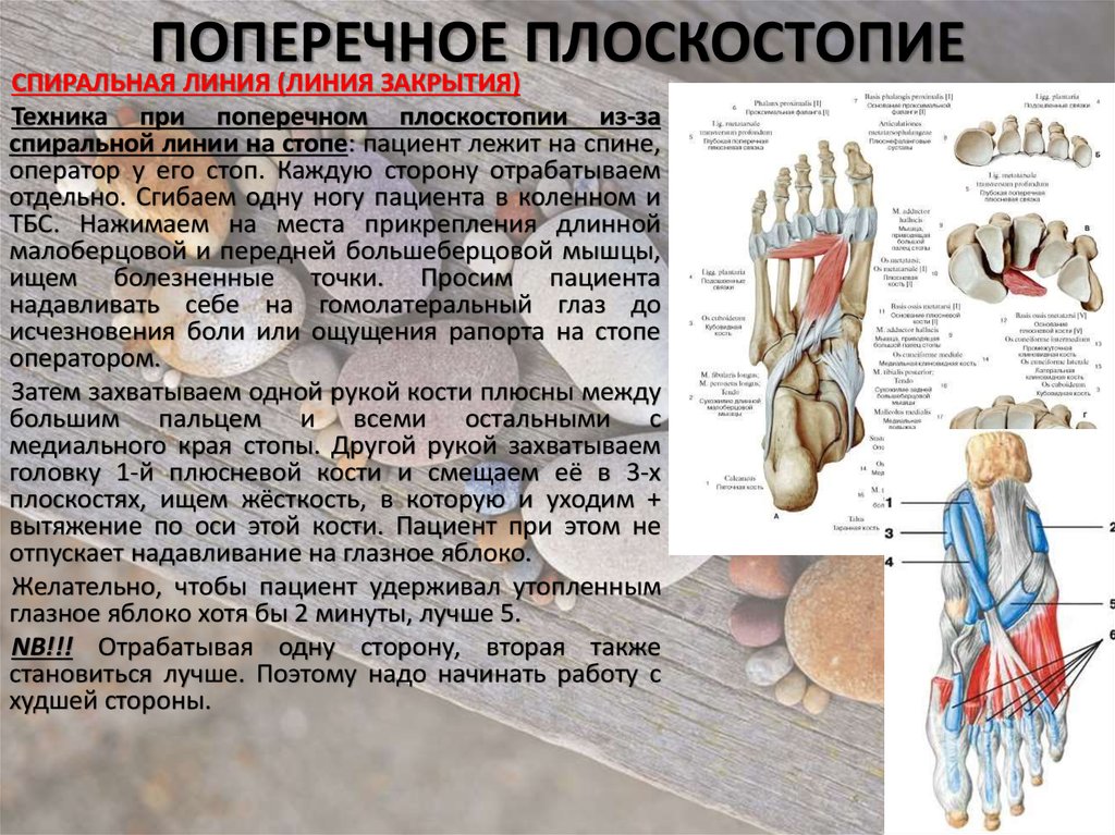 Поперечное плоскостопие