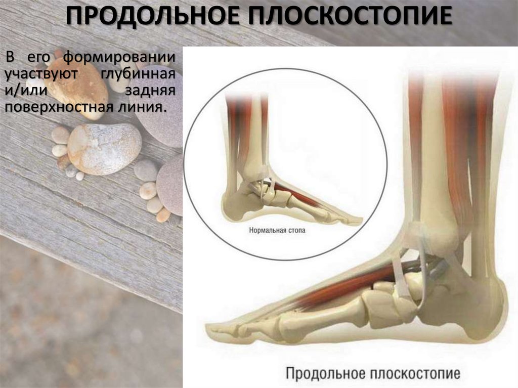 Продольное плоскостопие презентация