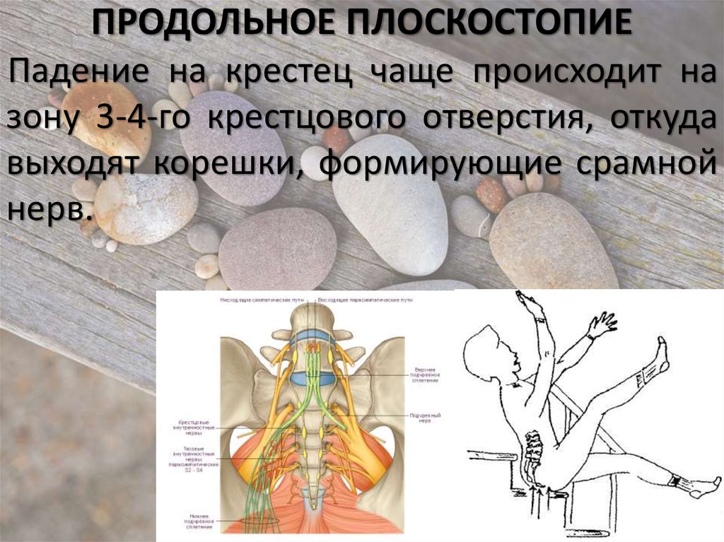 Продольное плоскостопие мкб