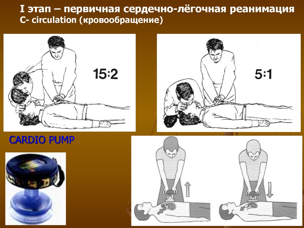 История и современность сердечно легочной реанимации презентация