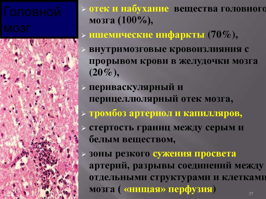 Оттек головного мозга. Ишемический инфаркт головного мозга гистология. Геморрагический инфаркт головного мозга патанатомия. Периваскулярный отек головного мозга. Отёк головного мозга патанатомия.