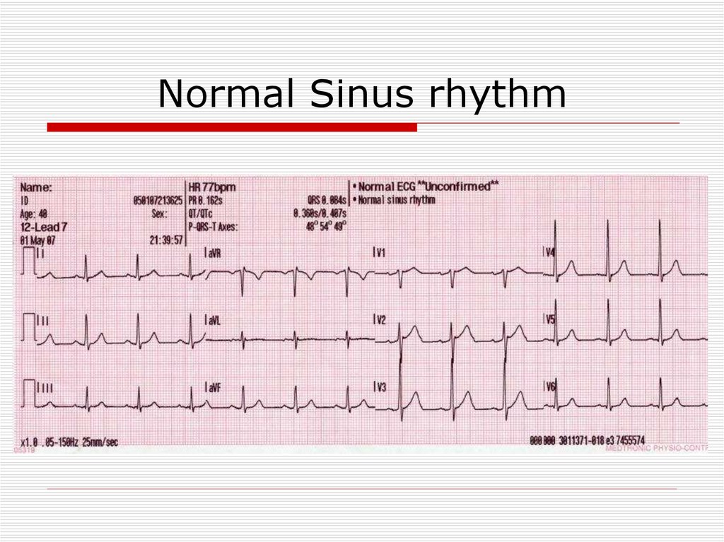 heart arrhythmia