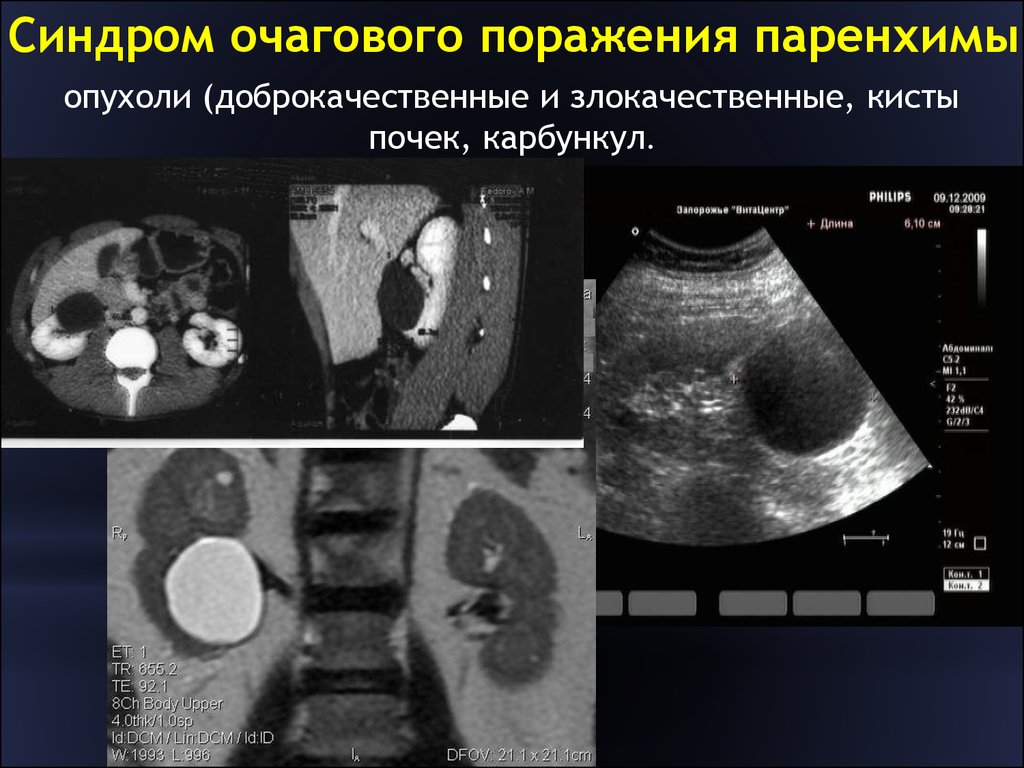 Очаговое поражение. Синдром очагового поражения паренхимы печени. Лучевое исследование почек.