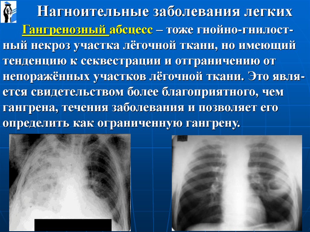 Как называется поражение. Болезни легких названия. Заболевания легких список.