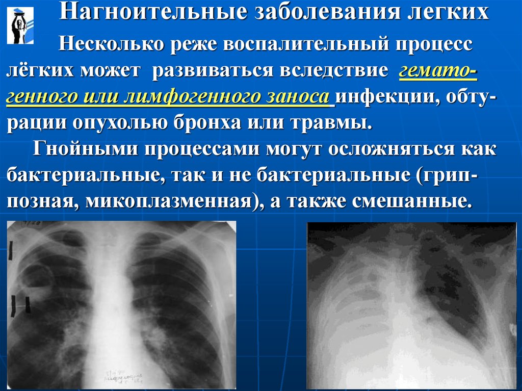 Нагноительные заболевания легких презентация