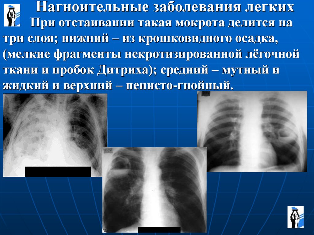 Фрагмент легкого. Нагноительные заболевания лёгких. Острые нагноительные заболевания легких. Хронические нагноительные заболевания легких.