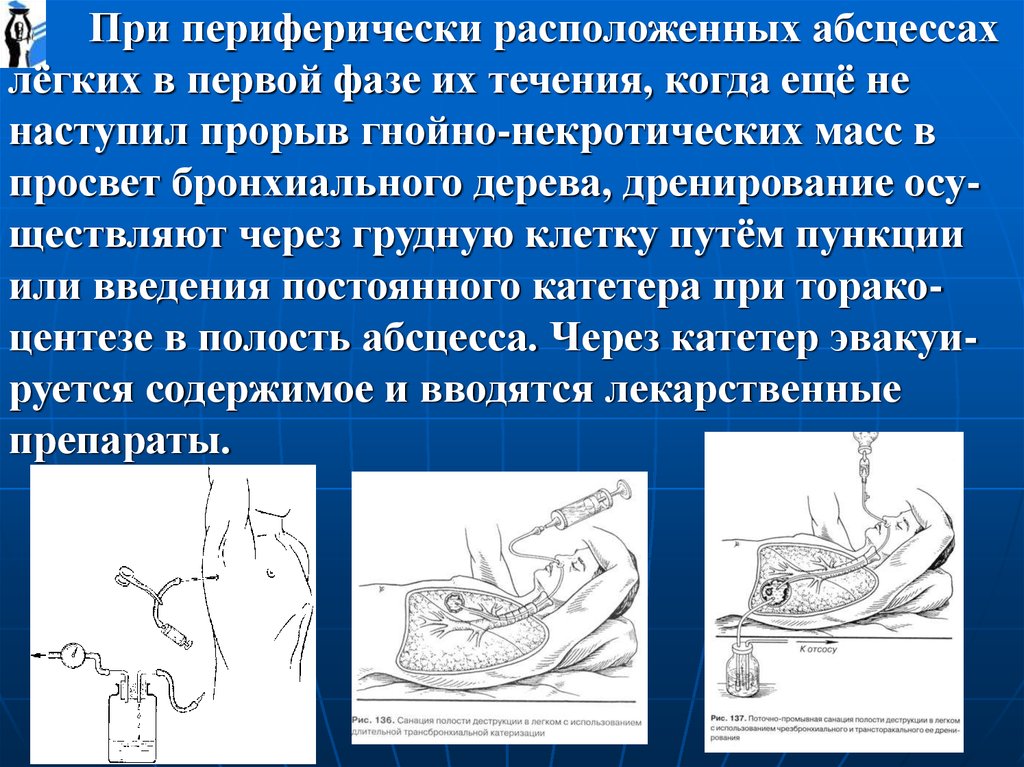 Центез. Дренирование при абсцессе легкого. Пункция абсцесса легкого. Пункция при абсцессе легкого. Дренирование бронхиального дерева при абсцессе легкого.