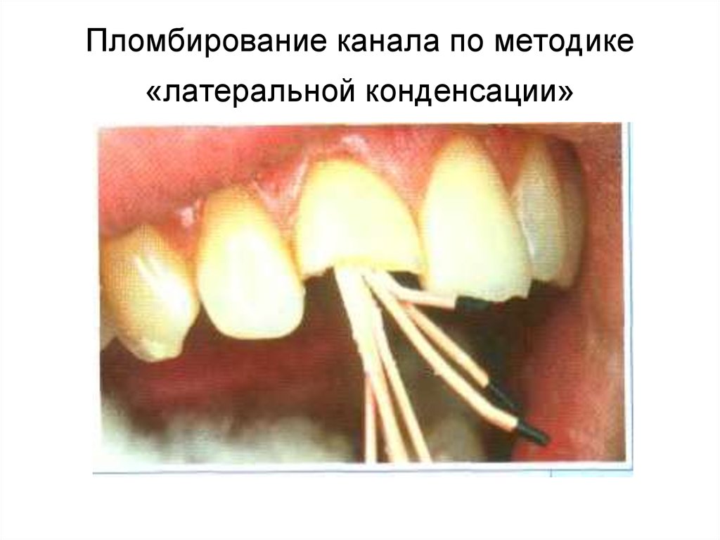 Пломбировка корневых каналов. Пломбирование зуба гуттаперчей методом латеральной конденсации. Пломбирование методом латеральной конденсации. Пломбирование корневых каналов гуттаперчей латеральная конденсация. Метод латеральной конденсации для пломбирования корневых каналов.