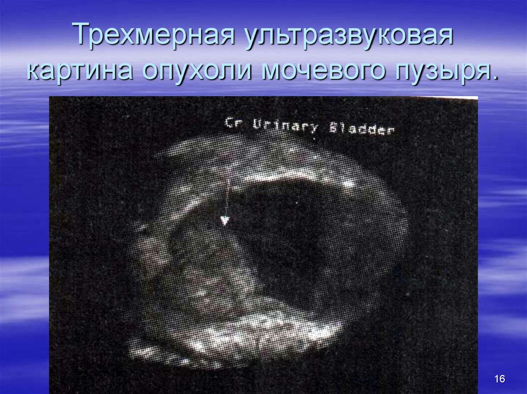 Трехмерная ультразвуковая картина опухоли мочевого пузыря.